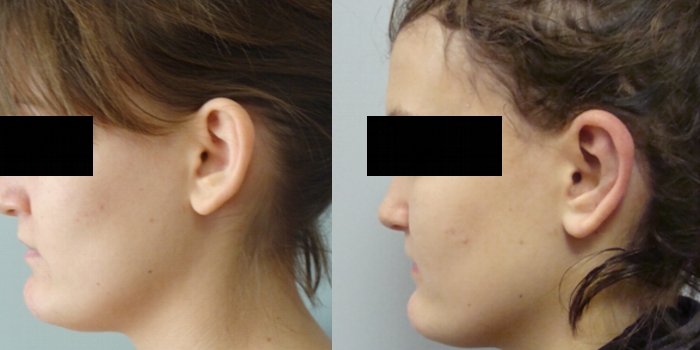 Otoplastika, nakon 7 dana
